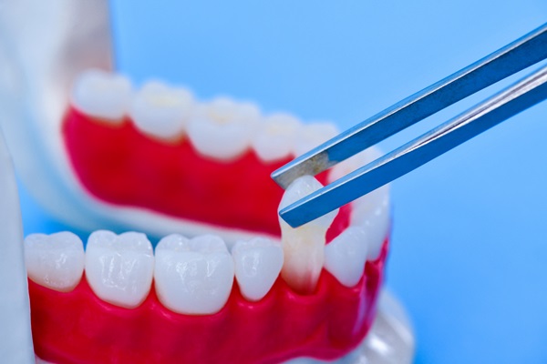 Dental Implants: Replacing A Tooth Root